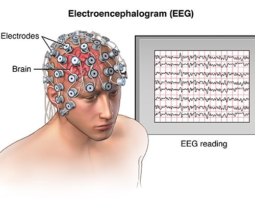 Oblique view of male head showing electrode placement on the scalp for an EEG (Electroencephalogram); SOURCE: Original; M_Brain_skull_EEG.mb